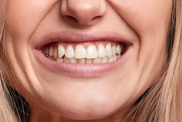 Diş Sıkma Fiyatları Şişli Nişantaşı Dentlotus