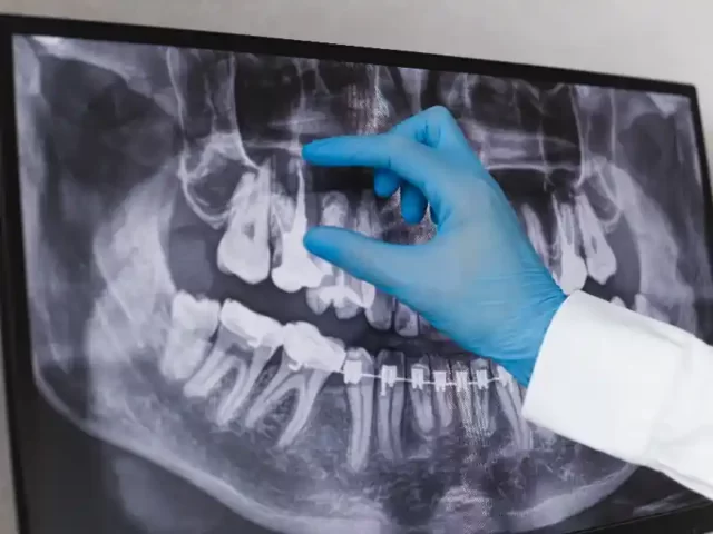 Kanal Tedavisi Endodonti Fiyatı Şişli