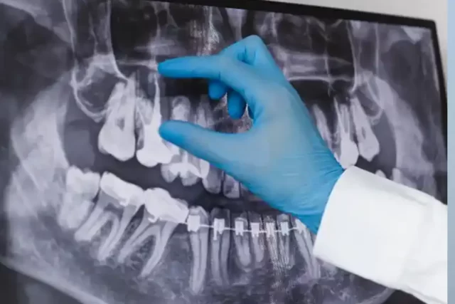 Kanal Tedavisi Endodonti Fiyatı WebP